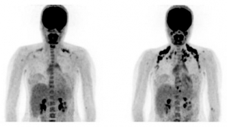PET-scans van een proefpersoon vóór en ná koudeblootstelling PET-scans van een proefpersoon vóór en ná koudeblootstelling